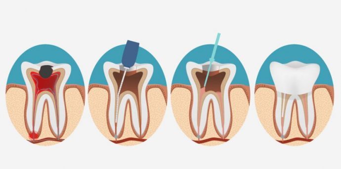 operation-dent-pivot