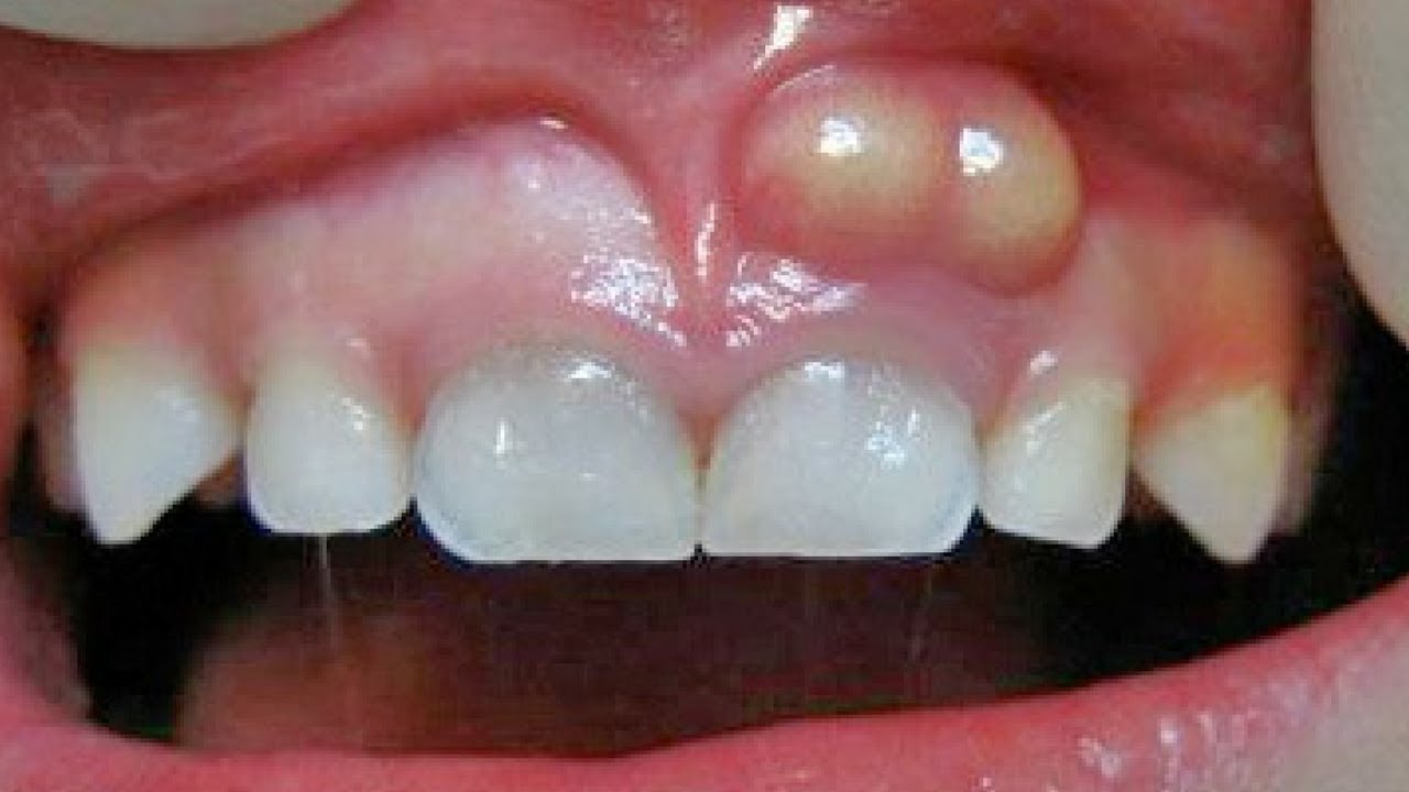 abces-dentaire