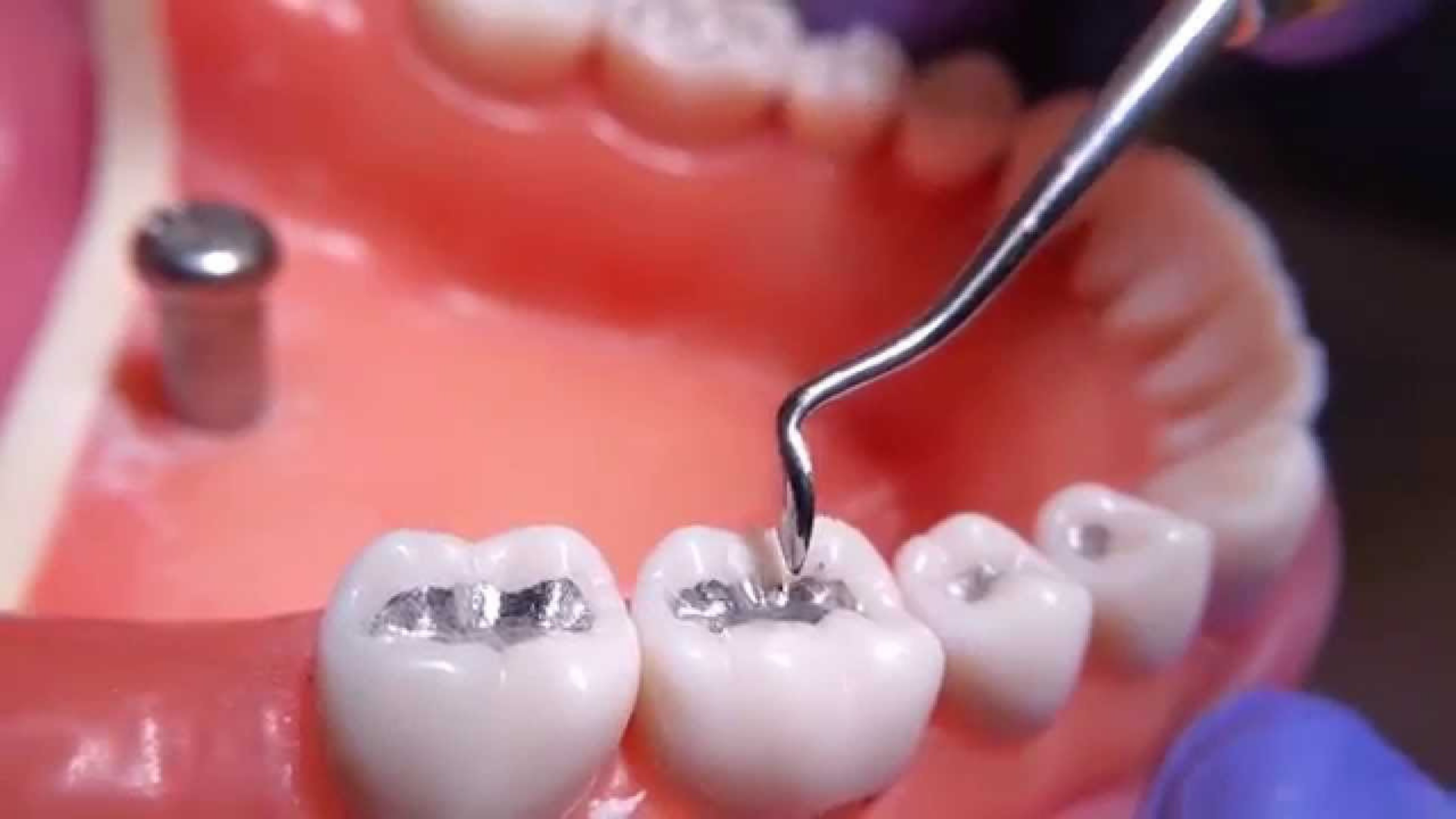 Эстетическое Пломбирование Зубов Цена