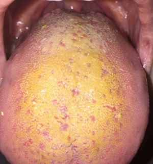 langue-jaune-infection