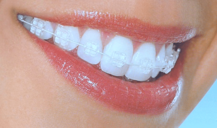 bagues-dentaires-transparentes