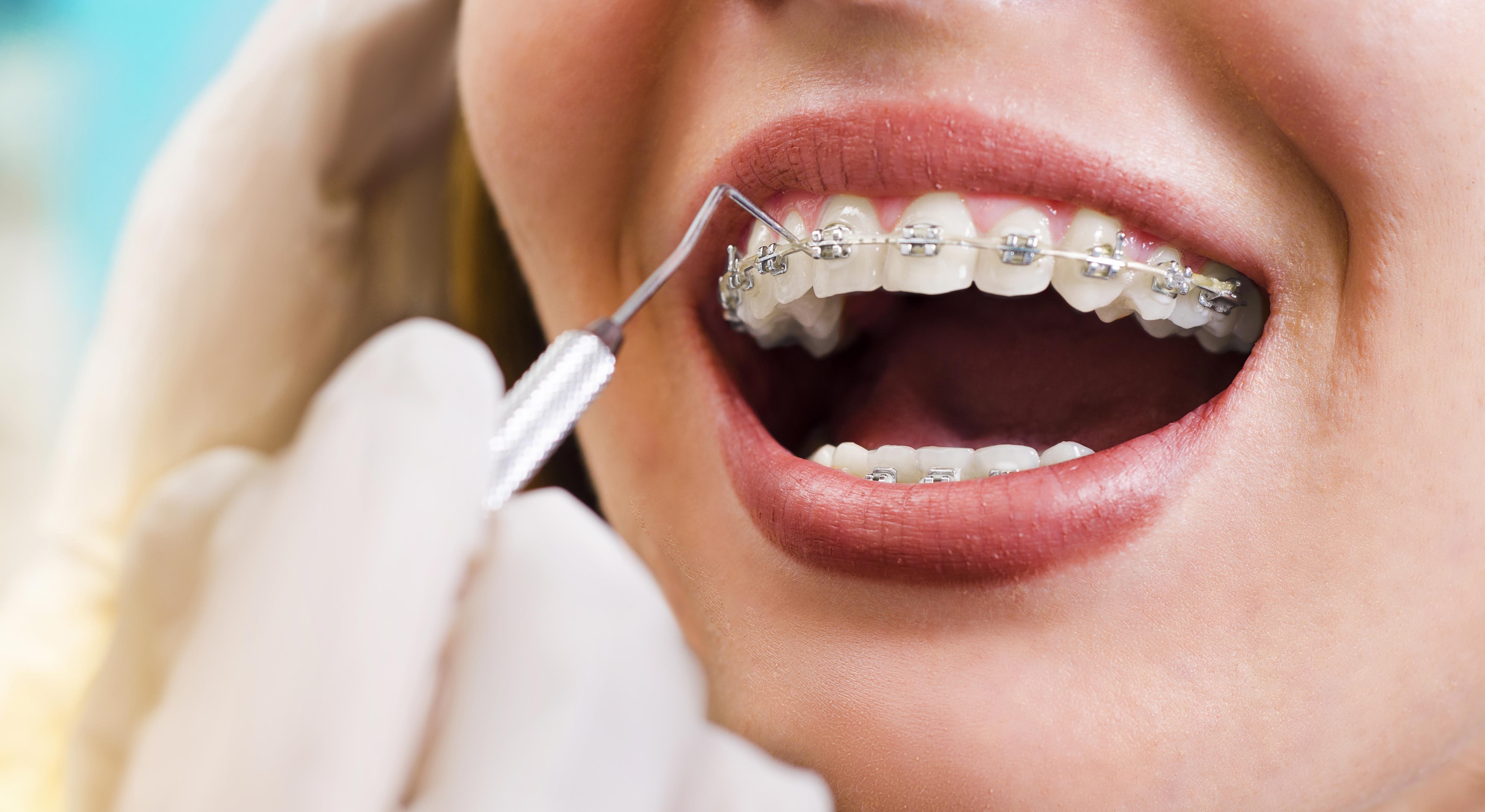 traitement-orthodontique