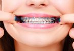 appareil-orthodontique