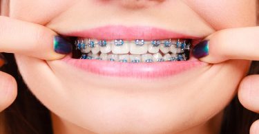 appareil-orthodontique