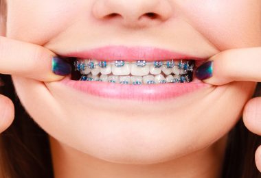 appareil-orthodontique