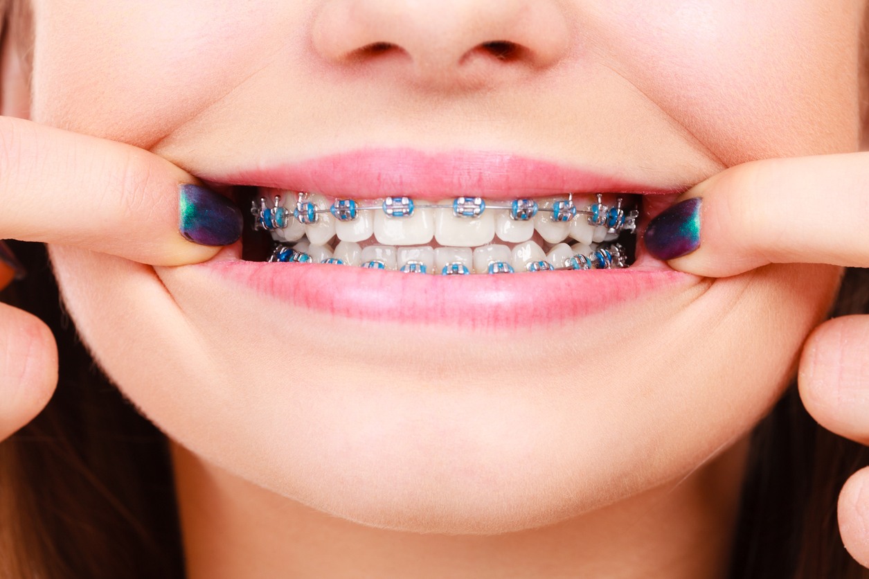 Appareils dentaires types, soins, à quoi s